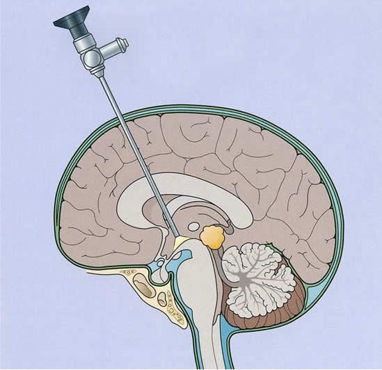 Endoscopia cerebral.jpg