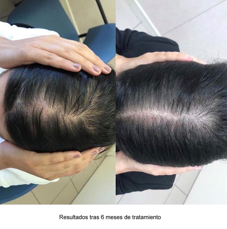 Consulta alopecia femenina_HQSJ.jpg